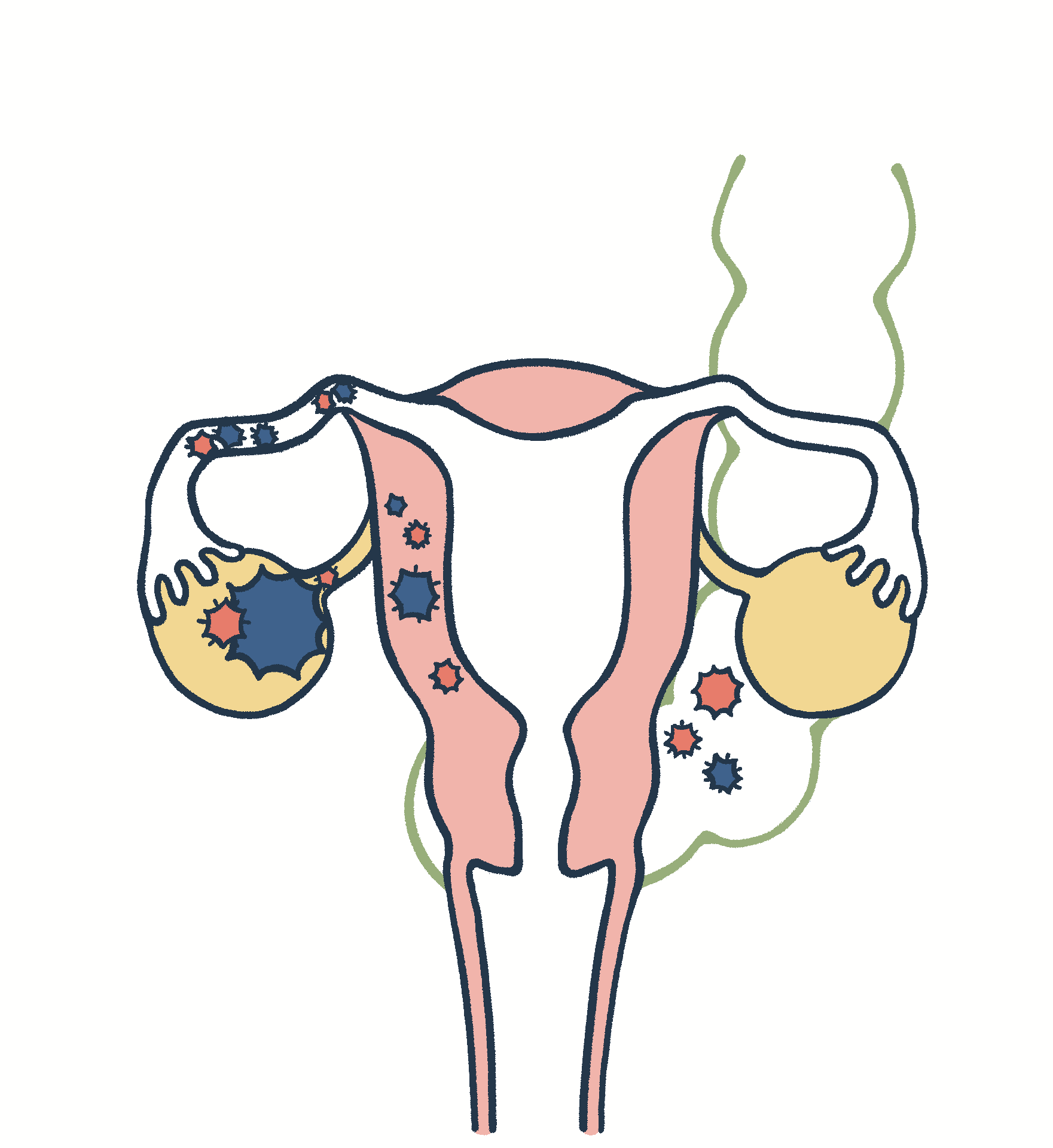 卵巣がんステージ2の図